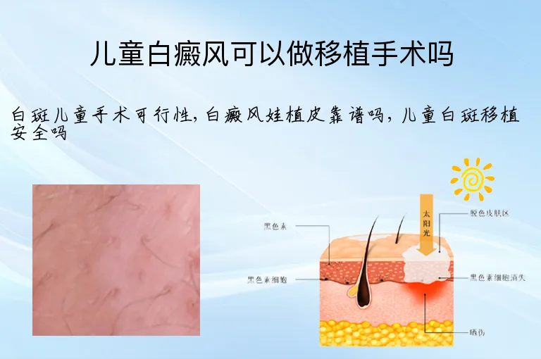 儿童白癜风可以做移植手术吗