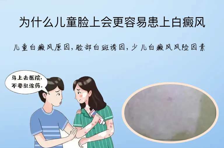 为什么儿童脸上会更容易患上白癜风