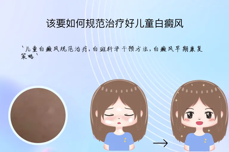 该要如何规范治疗好儿童白癜风