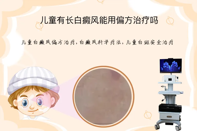 儿童有长白癜风能用偏方治疗吗