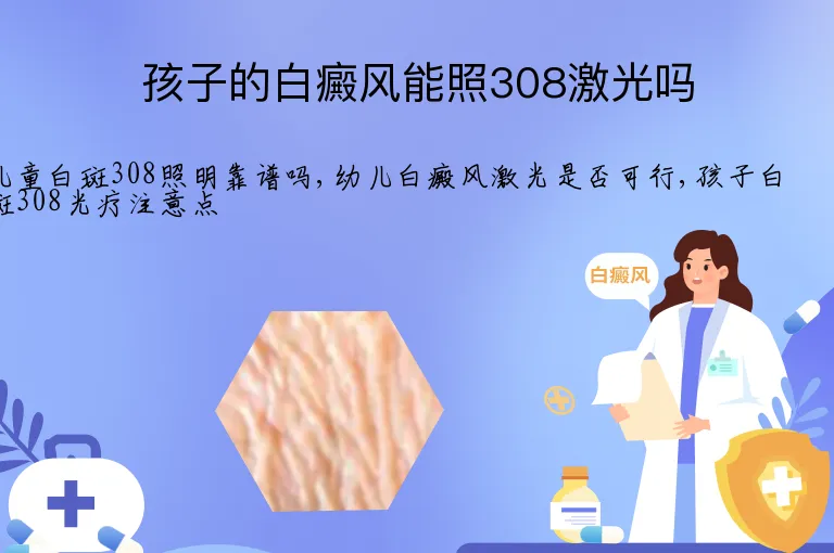 孩子的白癜风能照308激光吗