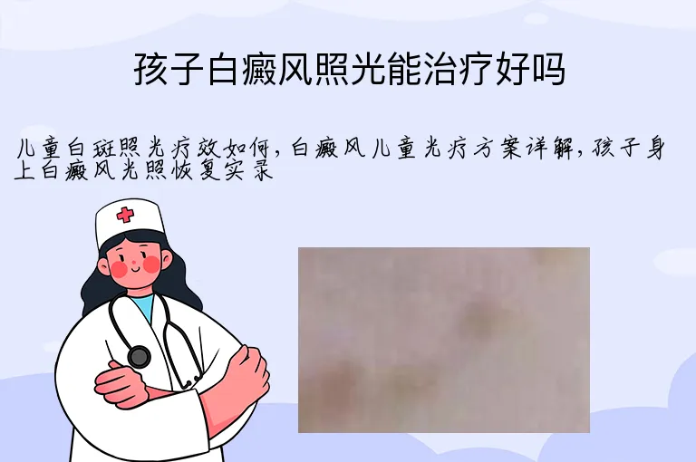 孩子白癜风照光能治疗好吗