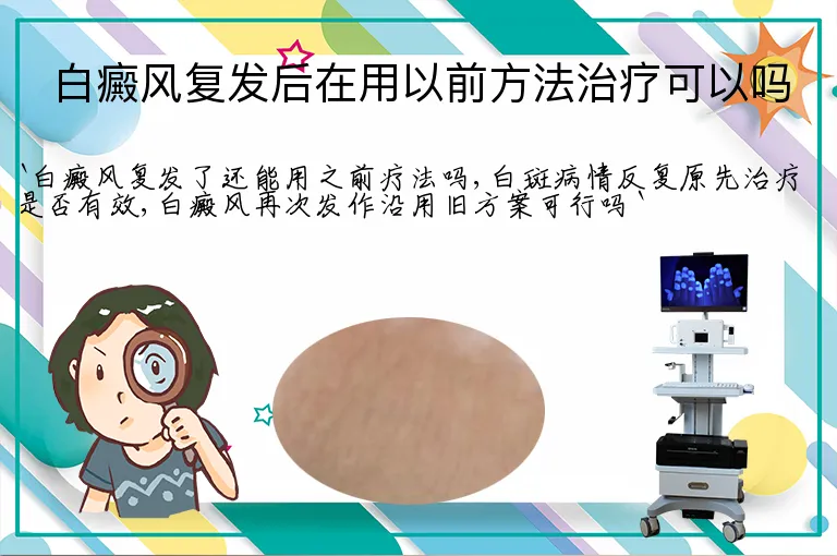 白癜风复发后在用以前方法治疗可以吗