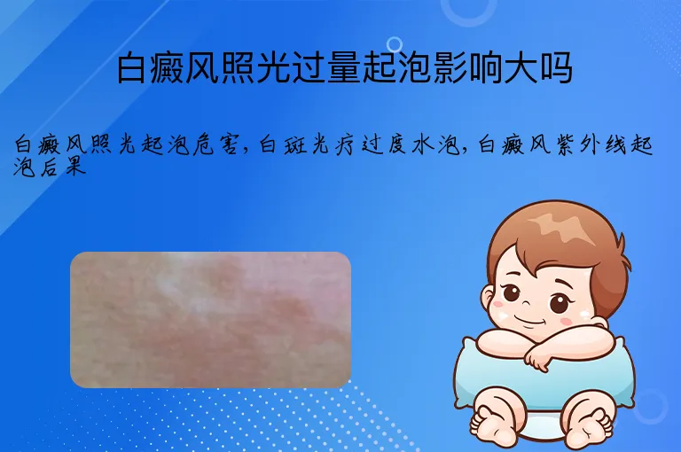白癜风照光过量起泡影响大吗