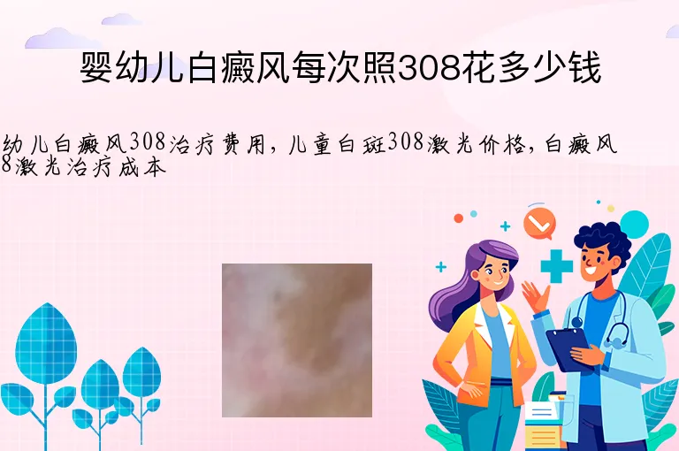 婴幼儿白癜风每次照308花多少钱