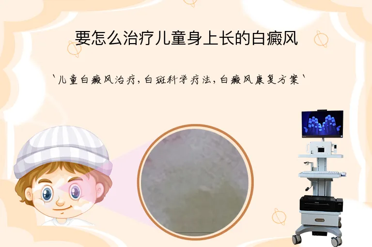 要怎么治疗儿童身上长的白癜风