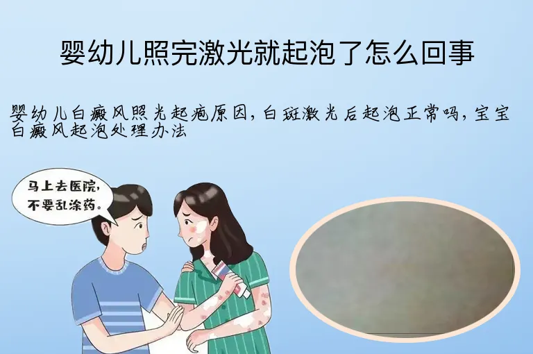 婴幼儿照完激光就起泡了怎么回事