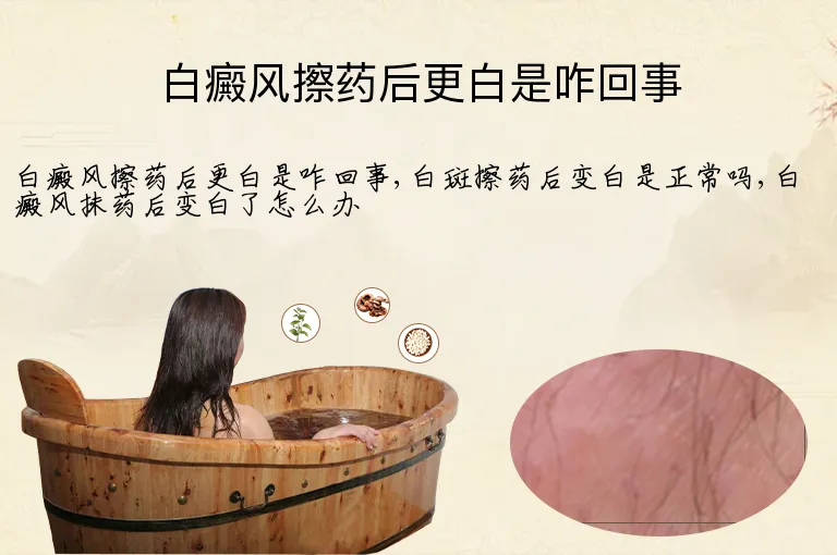 白癜风擦药后更白是咋回事