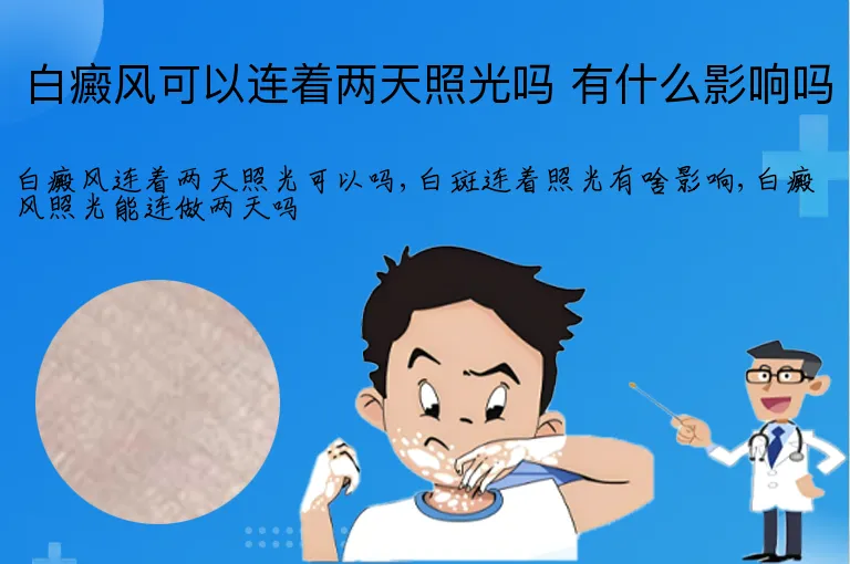 白癜风可以连着两天照光吗 有什么影响吗
