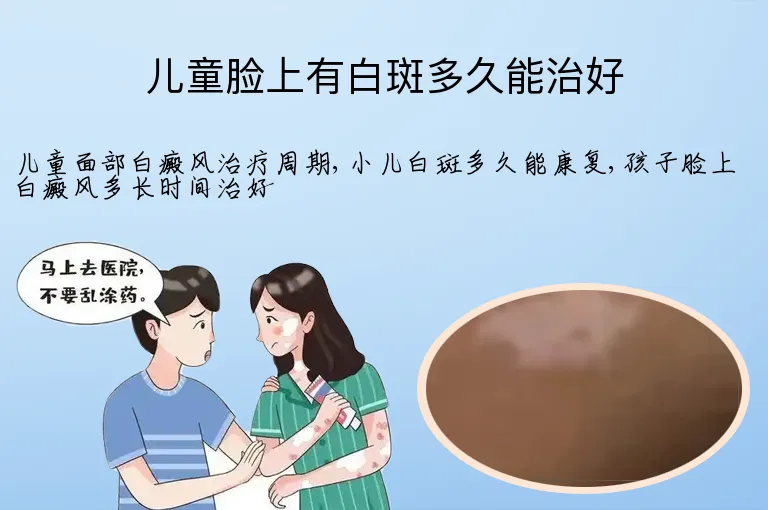 儿童脸上有白斑多久能治好