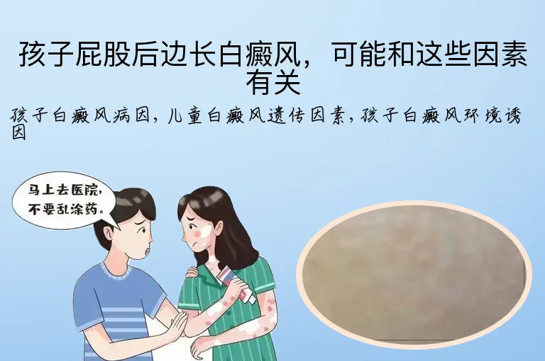 孩子屁股后边长白癜风，可能和这些因素有关
