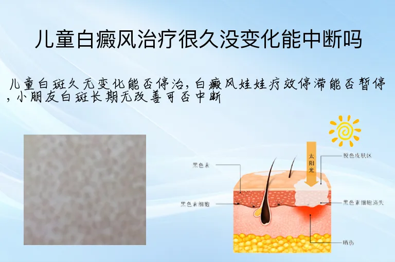 儿童白癜风治疗很久没变化能中断吗