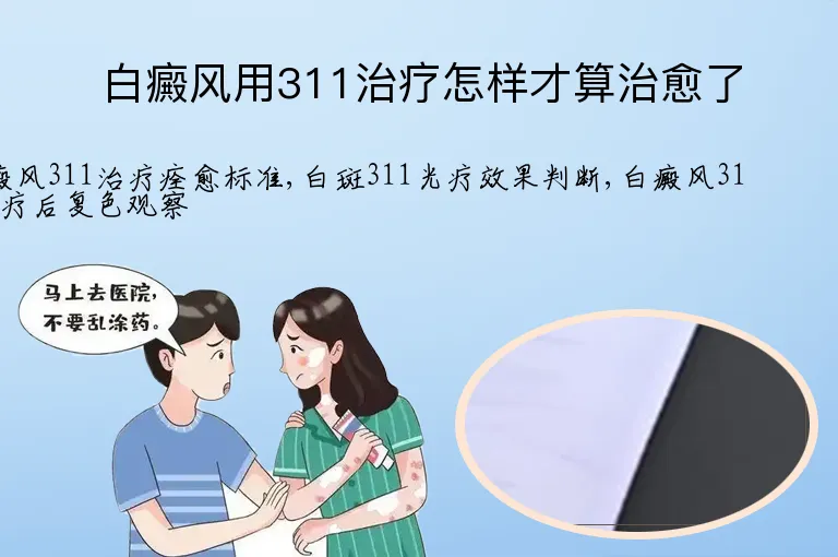 白癜风用311治疗怎样才算治愈了