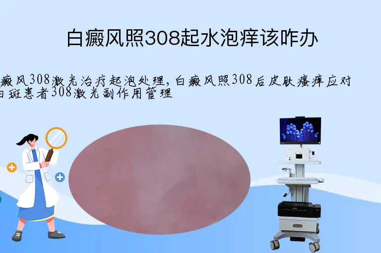 白癜风照308起水泡痒该咋办
