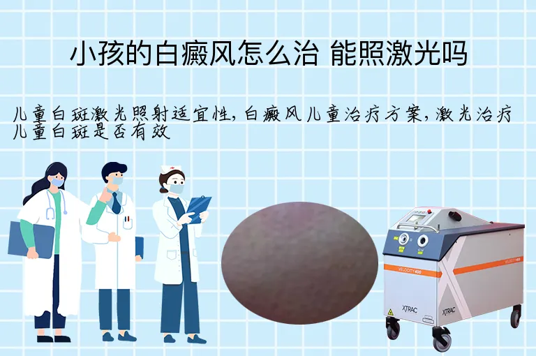 小孩的白癜风怎么治 能照激光吗