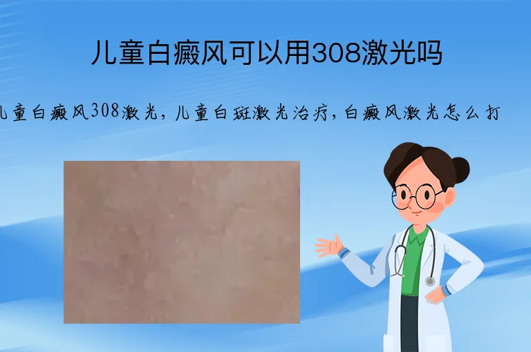 儿童白癜风可以用308激光吗