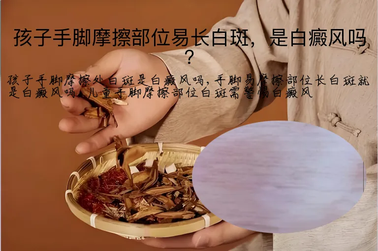 孩子手脚摩擦部位易长白斑,是白癜风吗?