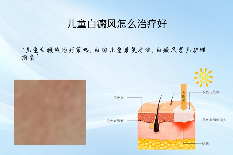 儿童白癜风怎么治疗好