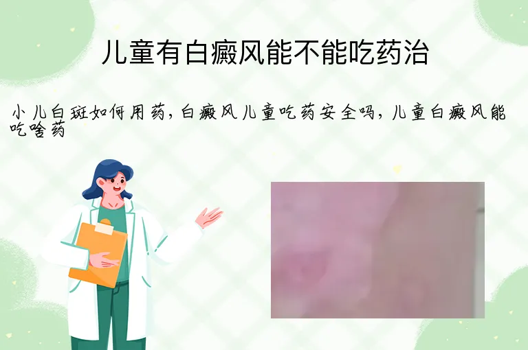 儿童有白癜风能不能吃药治