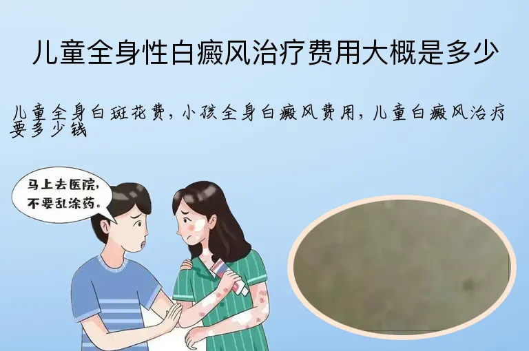 儿童全身性白癜风治疗费用大概是多少