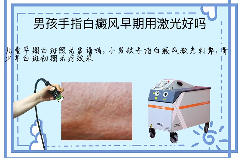 男孩手指白癜风早期用激光好吗