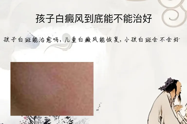 孩子白癜风到底能不能治好