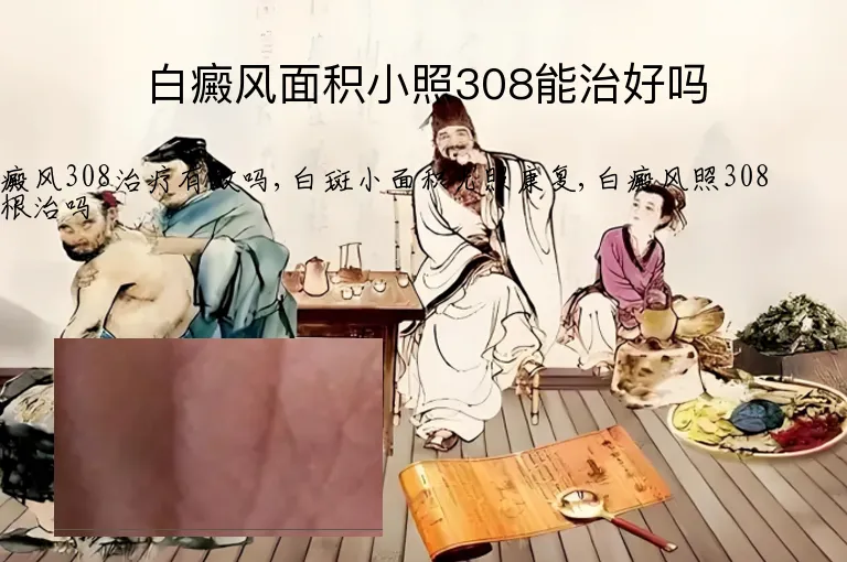 白癜风面积小照308能治好吗