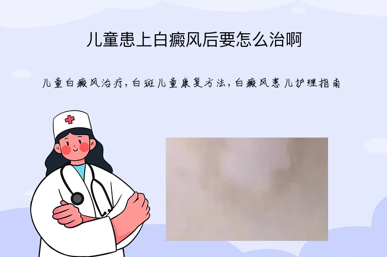 儿童患上白癜风后要怎么治啊