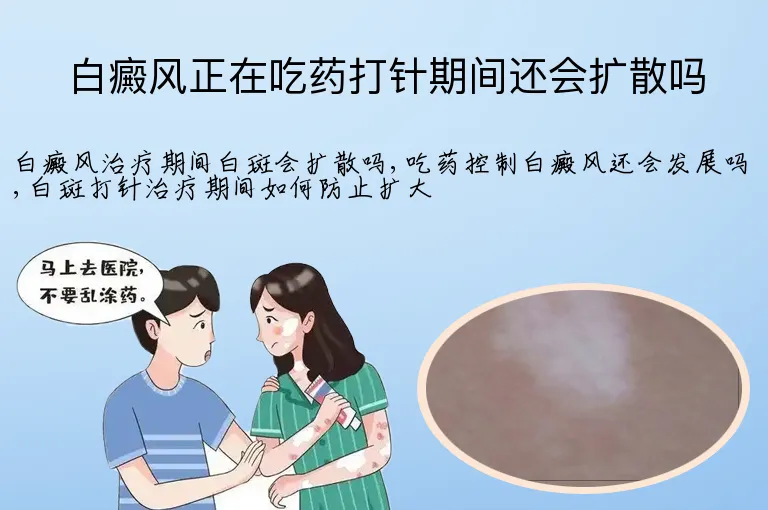 白癜风正在吃药打针期间还会扩散吗