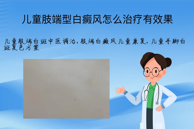 儿童肢端型白癜风怎么治疗有效果