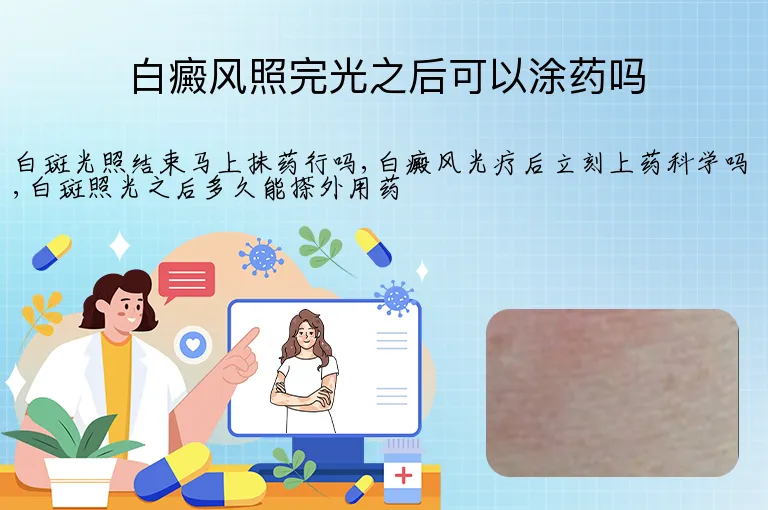 白癜风照完光之后可以涂药吗