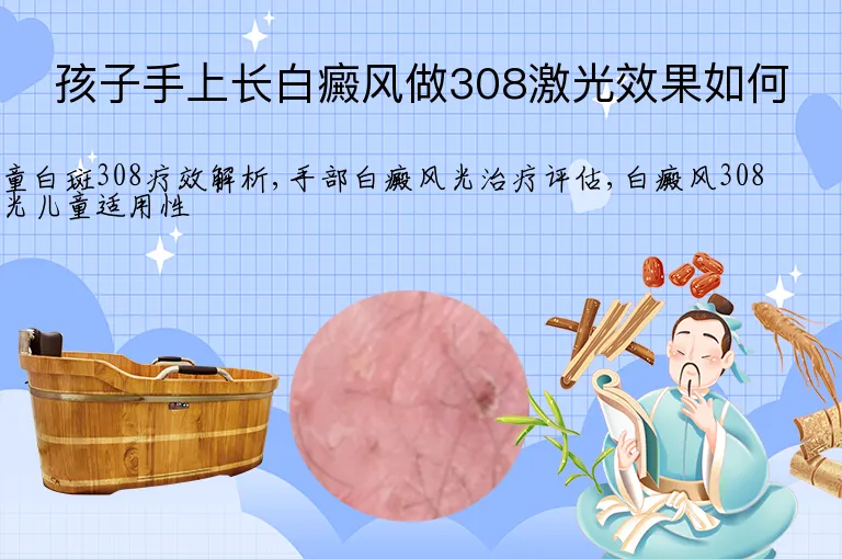 孩子手上长白癜风做308激光效果如何