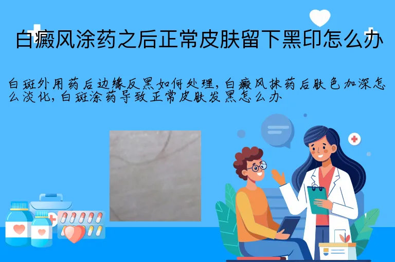 白癜风涂药之后正常皮肤留下黑印怎么办