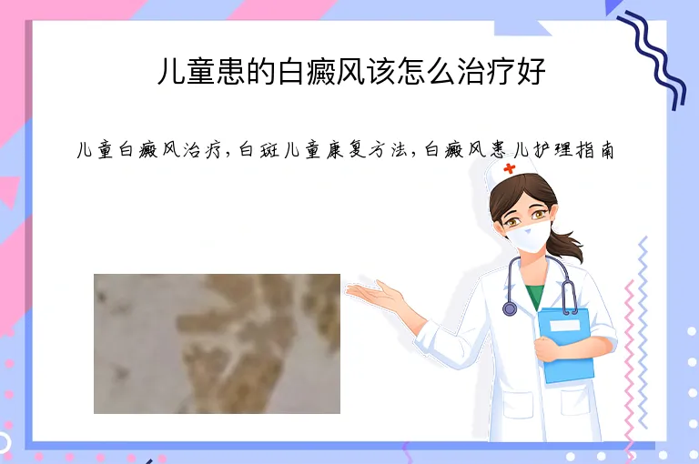 儿童患的白癜风该怎么治疗好