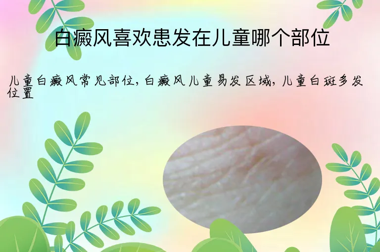 白癜风喜欢患发在儿童哪个部位