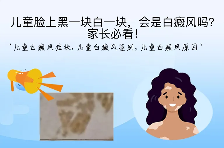 儿童脸上黑一块白一块,会是白癜风吗?家长必看!