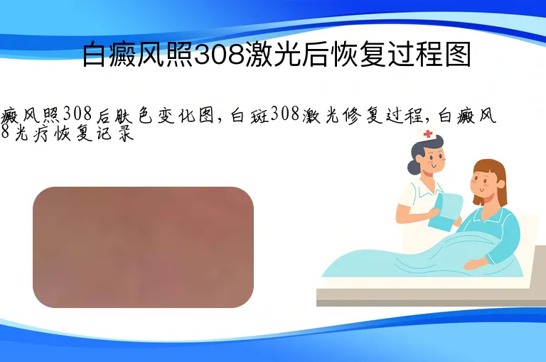 白癜风照308激光后恢复过程图