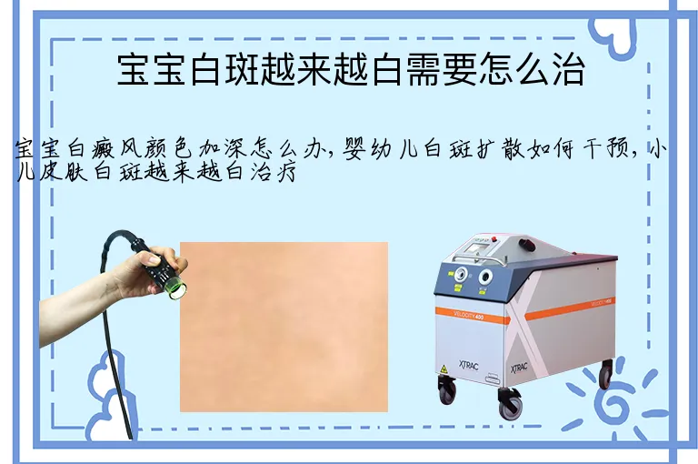 宝宝白斑越来越白需要怎么治