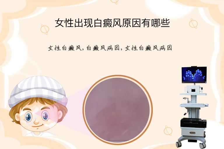 女性出现白癜风原因有哪些