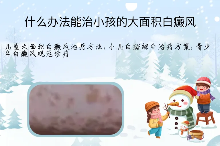 什么办法能治小孩的大面积白癜风