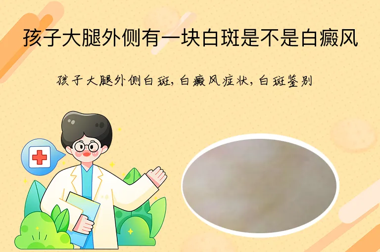 孩子大腿外侧有一块白斑是不是白癜风
