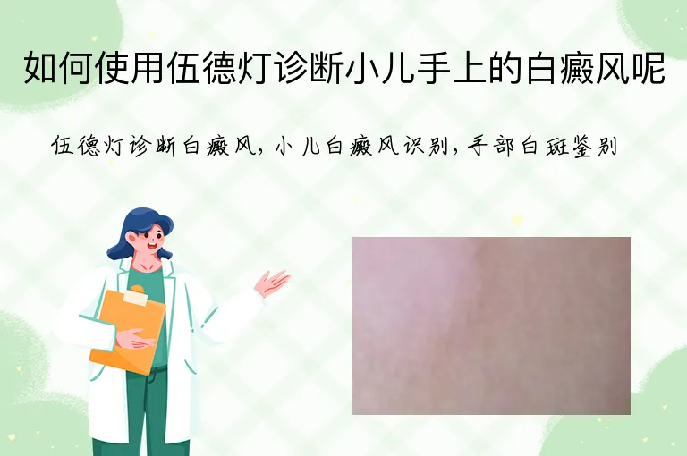 如何使用伍德灯诊断小儿手上的白癜风呢