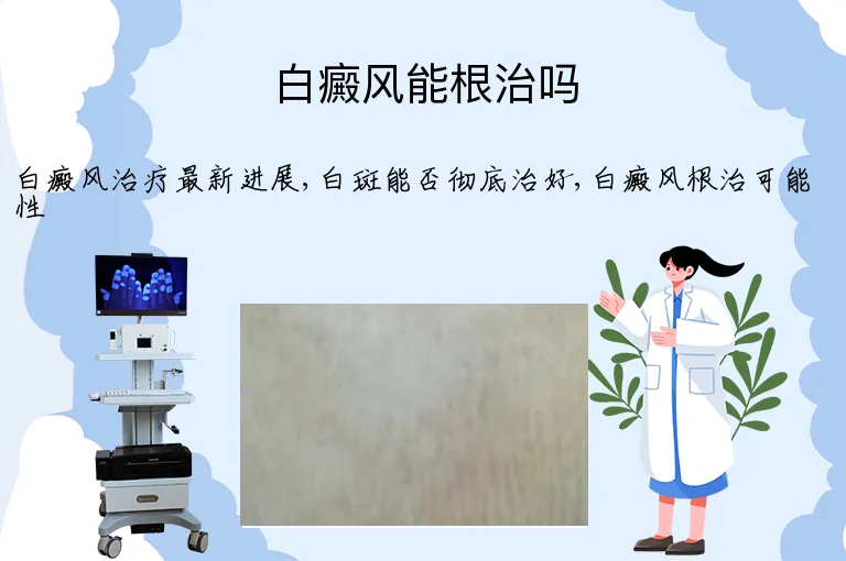 白癜风能根治吗