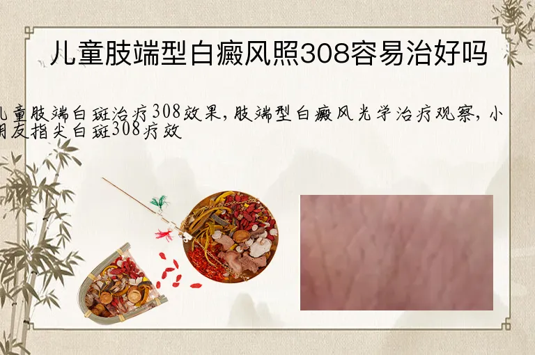 儿童肢端型白癜风照308容易治好吗