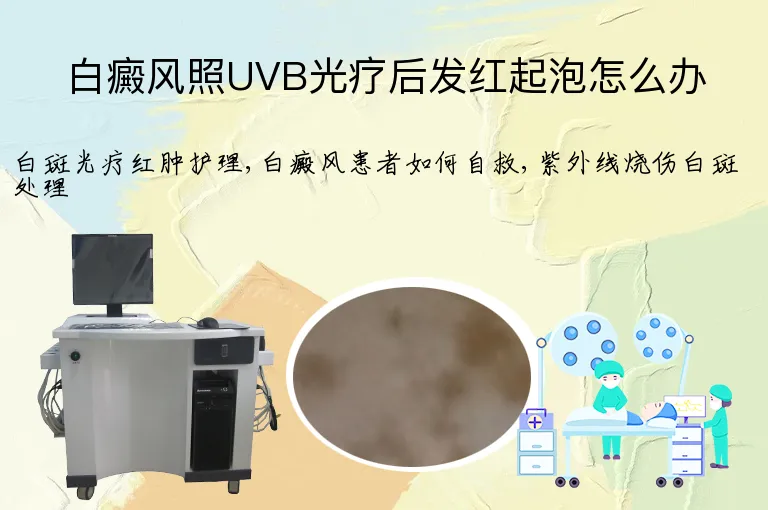 白癜风照UVB光疗后发红起泡怎么办