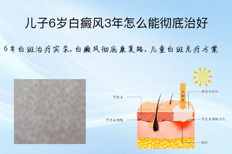 儿子6岁白癜风3年怎么能彻底治好