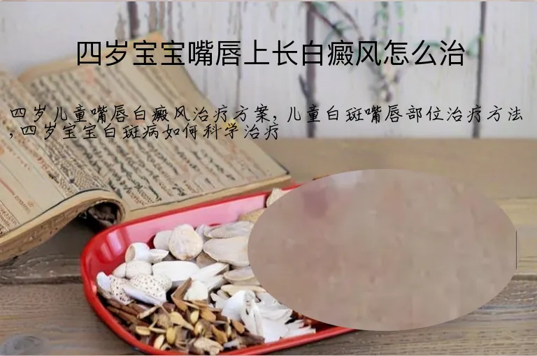 四岁宝宝嘴唇上长白癜风怎么治