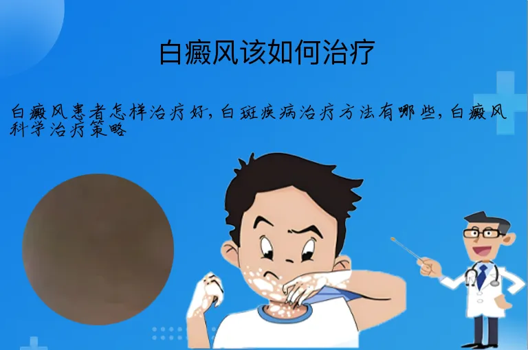 白癜风该如何治疗