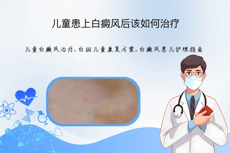 儿童患上白癜风后该如何治疗
