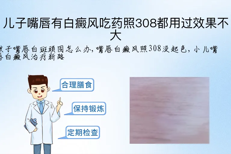 儿子嘴唇有白癜风吃药照308都用过效果不大